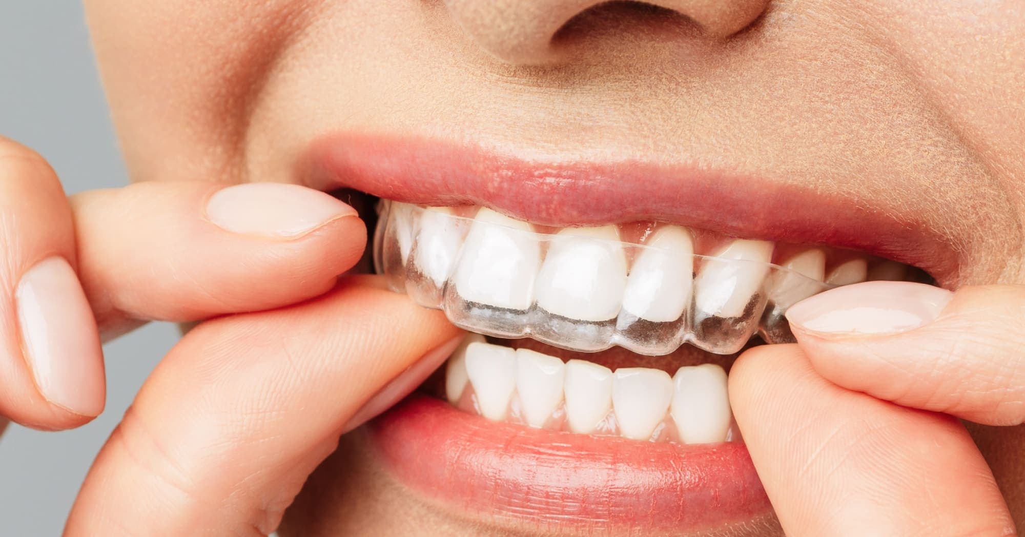 Digital Aligner